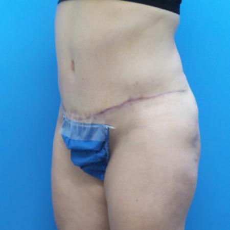 After image 2 Case #88171 - 41 year old  -  Abdominoplasty  -  3 months post-op