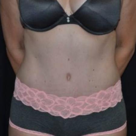 After image 1 Case #83766 - Abdominoplasty - 47 year old female.