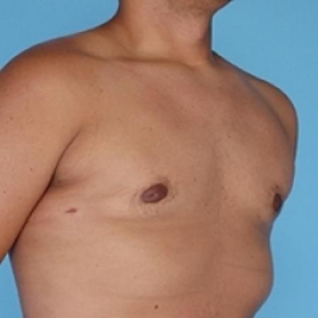 After image 3 Case #79271 - Male Breast Reduction