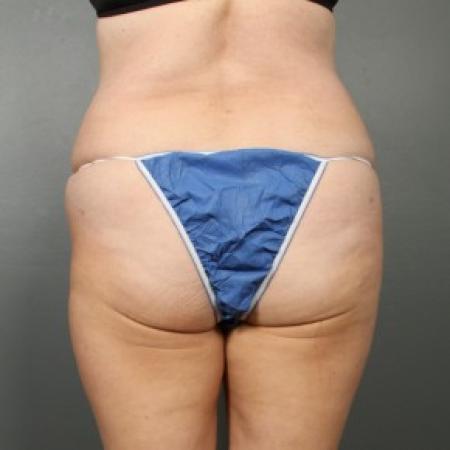 After image 3 Case #83611 - Liposuction Hips