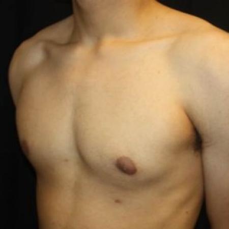 After image 2 Case #85276 - Gynecomastia - 17 year old male 