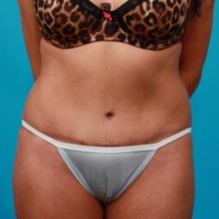 After image 1 Case #78861 - Extended Abdominoplasty