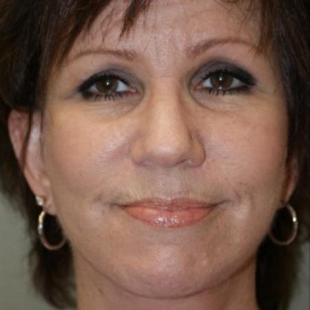 After image 1 Case #81901 - Facelift 