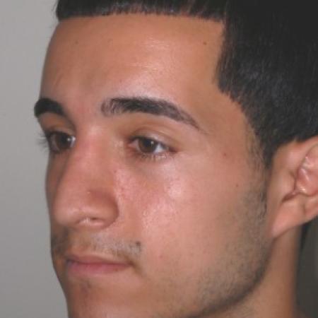 After image 1 Case #87211 - Rhinoplasty