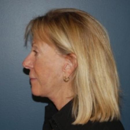 After image 2 Case #81056 - Facelift