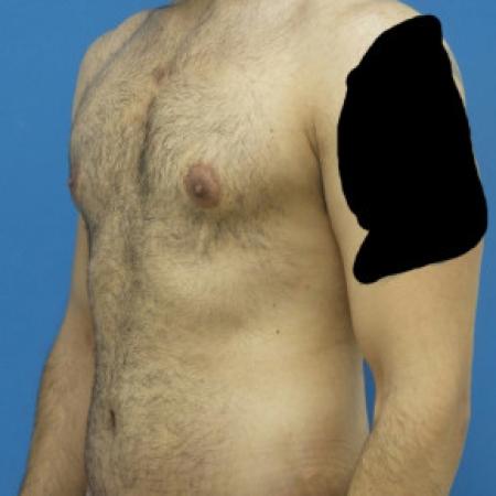 After image 2 Case #88446 - 34 year old  -  Gynecomastia Reduction/Circumferential Body Lift -  3 months post-op 