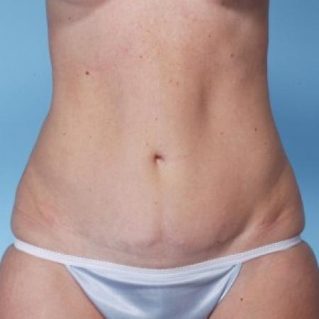 After image 1 Case #82296 - Abdominoplasty 