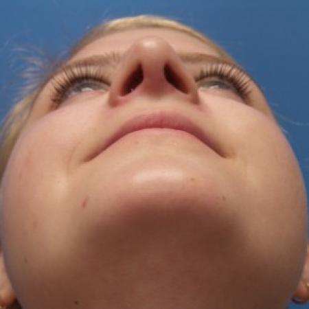 After image 4 Case #87221 - 18 year old - Rhinoplasty/Septoplasty/Turbinectomy  -  5 months post-op