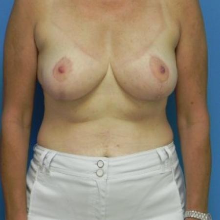 After image 1 Case #81921 - Bilateral Breast Reduction