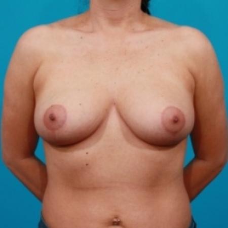After image 1 Case #78661 - Breast Lift