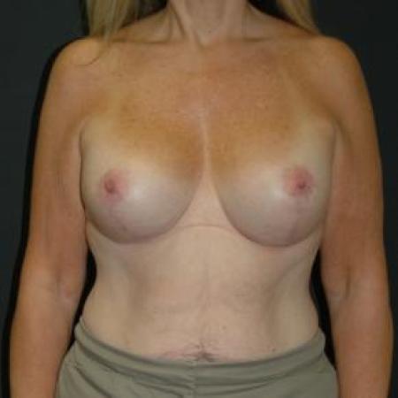 After image 1 Case #80866 - Mastopexy with Breast Augmentation