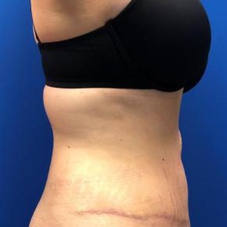 After image 2 Case #88361 - Lipoabdominoplasty on a 32 year old female