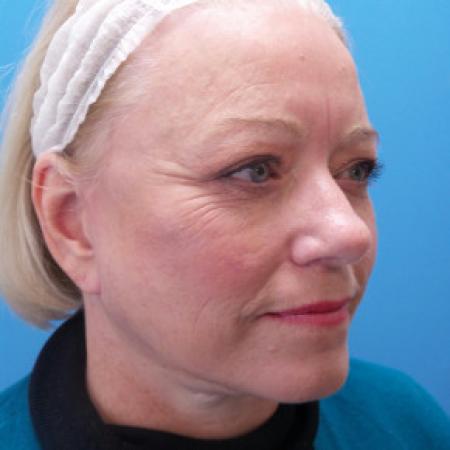 After image 2 Case #88146 - 66 year old - Facelift/Upper & Lower Blepharoplasty/Skin Resurfacing - 4 months post-op