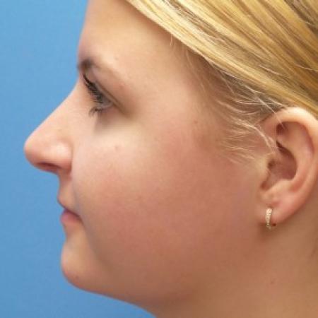 After image 3 Case #87221 - 18 year old - Rhinoplasty/Septoplasty/Turbinectomy  -  5 months post-op