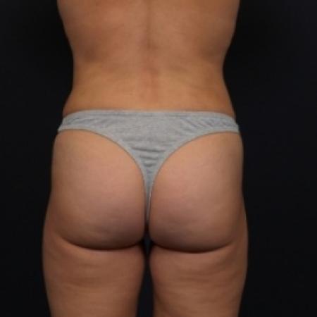 After image 1 Case #79631 - Liposuction