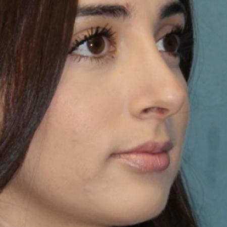 After image 2 Case #80826 - Rhinoplasty