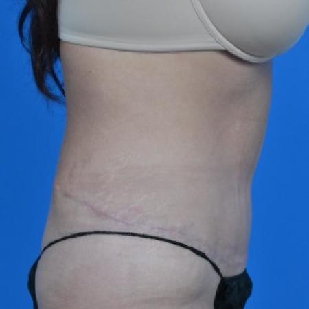 After image 3 Case #87881 - Tummy Tuck