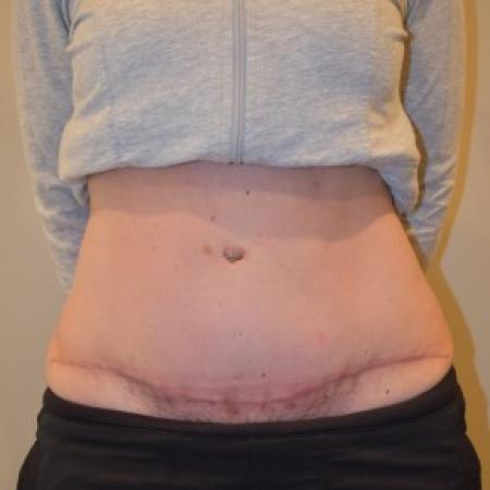 After image 1 Case #85816 - Abdominoplasty with diastasis repair