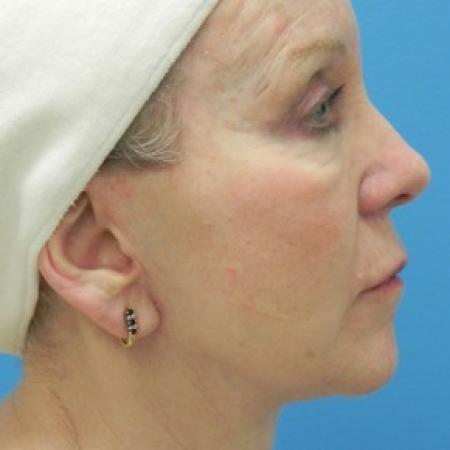After image 3 Case #86616 - Facelift/Upper & Lower Blepharoplasty/Laser Resurfacing to Full Face/Juvederm      7 months post-op