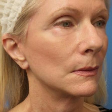 After image 2 Case #86581 - Facelift/Upper Blepharoplasty     2 months post-op
