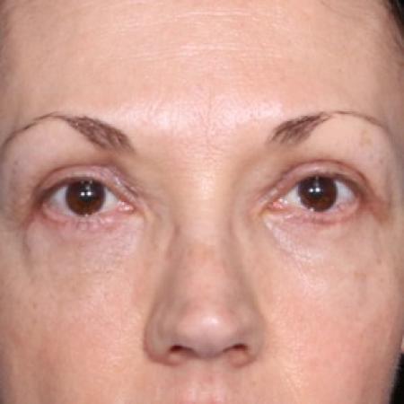 After image 1 Case #85031 - 50 Years old female