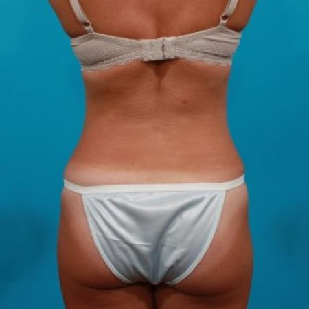 After image 5 Case #84106 - Abdominoplasty with Flank Lipo