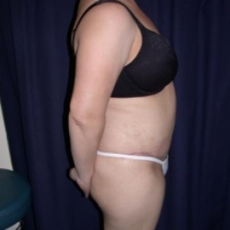 After image 2 Case #79816 - Tmmy Tuck/ Lipo-Abdominoplasty