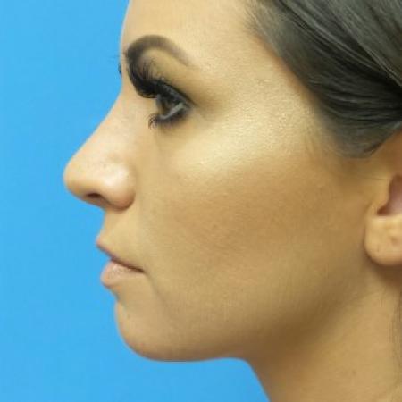 After image 3 Case #86756 - Rhinoplasty - 3 months post-op