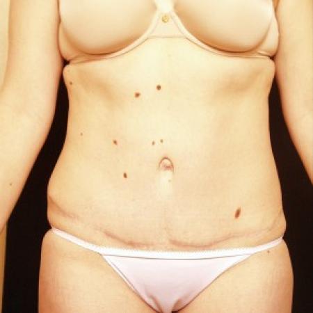 After image 1 Case #81726 - Tummy Tuck