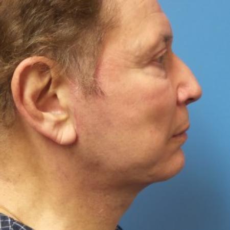 After image 3 Case #86571 - Facelift/Chin Augmentation with Implant     7 months post-op