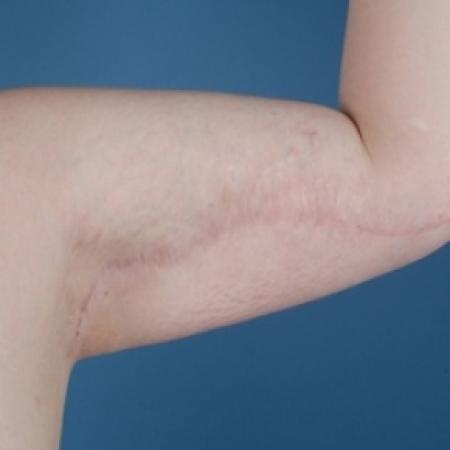 After image 1 Case #79016 - Arm Lift