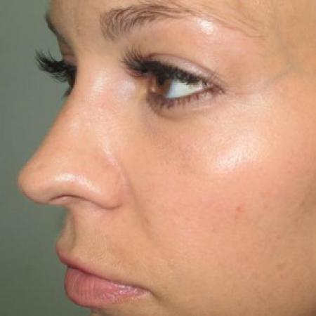 After image 2 Case #82706 - Fat Transfer to lower lids