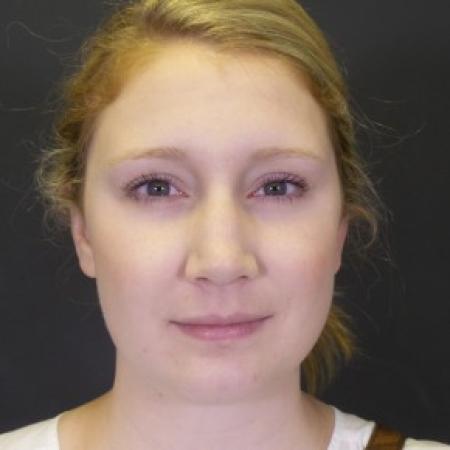 After image 1 Case #84146 - Chin Liposuction
