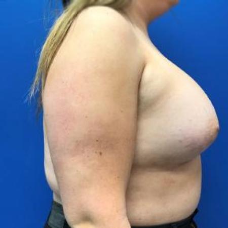 After image 2 Case #88191 - Left Breast Reduction and Right Breast Augmentation on a 22 year old patient