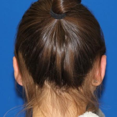 After image 2 Case #79941 - Otoplasty Ear surgery
