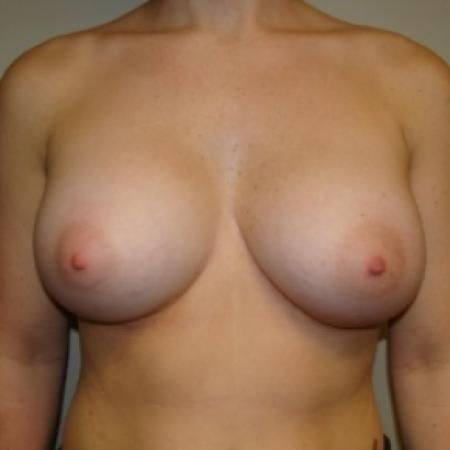 After image 1 Case #79341 - Breast Augmentation