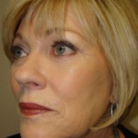 After image 3 Case #79056 - Facelift