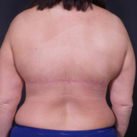 After image 2 Case #84566 - Backlift