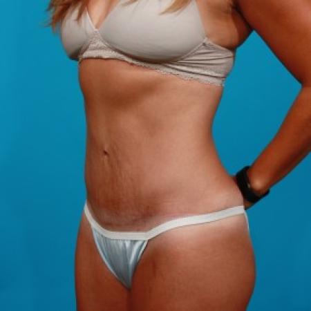 After image 2 Case #81941 - Abdominoplasty
