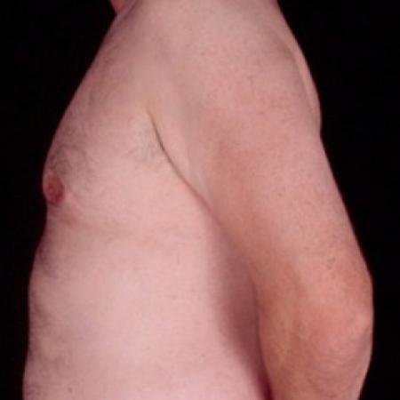 After image 2 Case #81506 - Gynecomastia