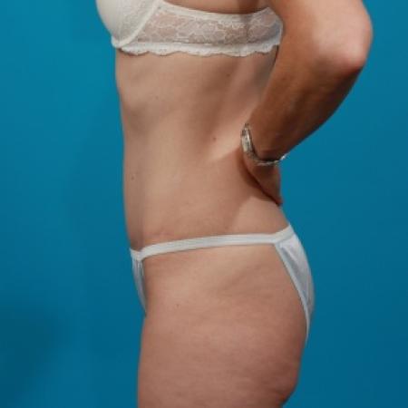After image 3 Case #80516 - Tummy Tuck