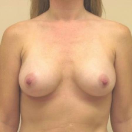After image 1 Case #81026 - Breast Augmentation