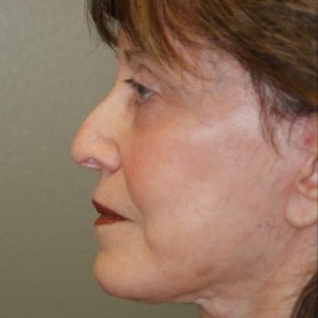 After image 3 Case #81916 - Facelift