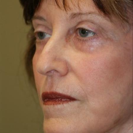 After image 2 Case #81916 - Facelift