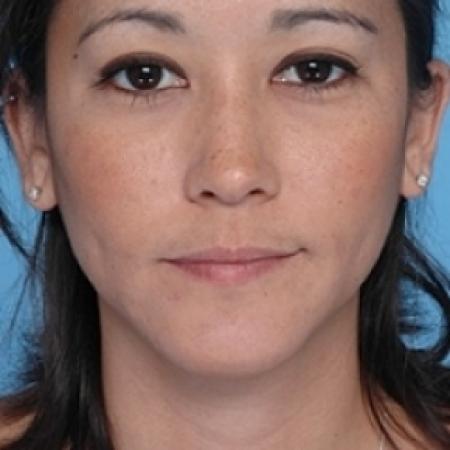 After image 1 Case #79201 - Liposuction