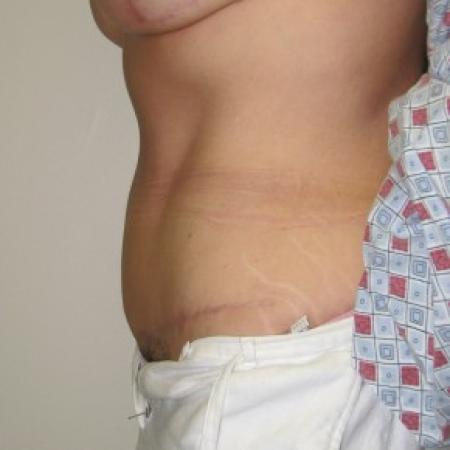 After image 3 Case #85806 - Massive weight loss patient with Fleur-de-Lis abdominoplasty