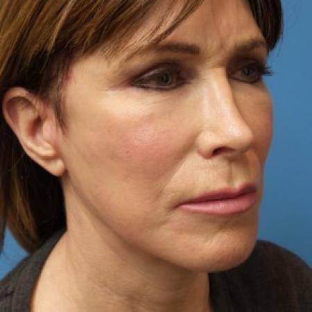 After image 2 Case #86561 - Facelift/ Upper Blepharoplasty/Laser Resurfacing to Full Face     2 months post-op