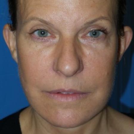 After image 1 Case #86591 - Facelift/Upper Blepharoplasty     3 months post-op
