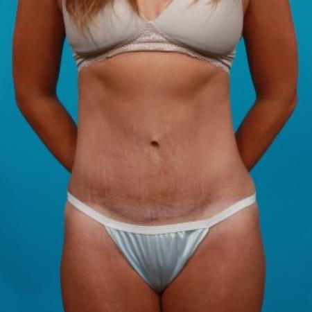 After image 1 Case #84106 - Abdominoplasty with Flank Lipo