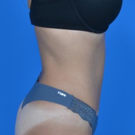 After image 2 Case #87841 - Tummy Tuck
